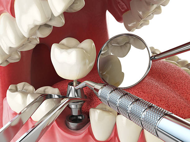 Best Chipped Tooth Repair Near Me  in Pleasant Hill, IA